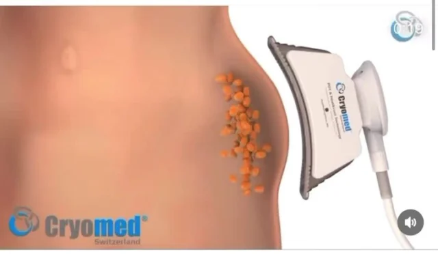 📌Bist du bereit, dein Wunschgewicht zu erreichen? 🍀Kryolipolyse könnte der Schlüssel zu deinem Traumkörper sein! 
Diese innovative Methode zur Fettreduzierung nutzt Kalte, um Fettzellen gezielt zu zerstören, ohne dabei das umliegende Gewebe zu schädigen.
#Lüneburg

🍀🍀Kombination dazu EM Shape X

Bist du bereit, deinen Körper auf das nächste Level zu bringen? 

⬇️⬇️⬇️EMShape X ist die revolutionäre Behandlung,
die dir hilft, Muskeln aufzubauen und gleichzeitig Fett zu reduzieren - ganz ohne Fitnessstudio in Lüneburg ❤️

Mit hochintensiven elektromagnetischen Impulsen stimuliert
EM Shape X deine Muskeln, fördert deren Wachstum und sorgt für sichtbar straffere Konturen. 
Ideal für alle, die schnelle Ergebnisse sehen wollen! 

Hast du Fragen zu EM Shape X oder möchtest du mehr darüber erfahren? 
Lass es uns in den Kommentaren wissen!

#EMSCULPT #Muskelaufbau #FitnessRevolution
In Lüneburg gibt es mittlerweile viele Möglichkeiten, diese Behandlung auszuprobieren. Wenn du mehr über die Vorteile und die Abläufe erfahren möchtest, lass es uns wissen!
Hast du schon Erfahrungen mit Kryolipolyse gemacht? Teile deine Gedanken in den Kommentaren!
#Kryolipolyse #Lüneburg #fettabbau #fettabbauen